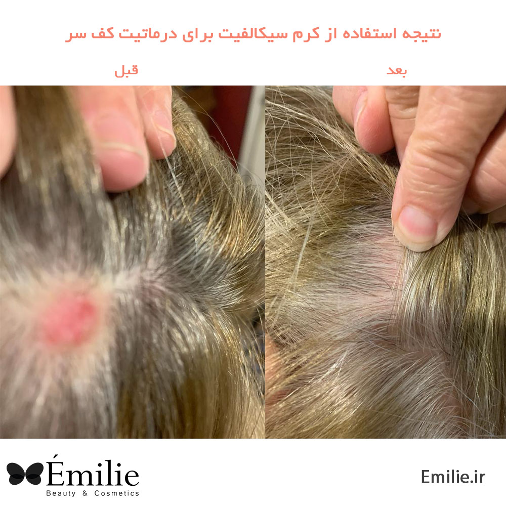 قبل و بعد از استفاده از کرم سیکالفیت1