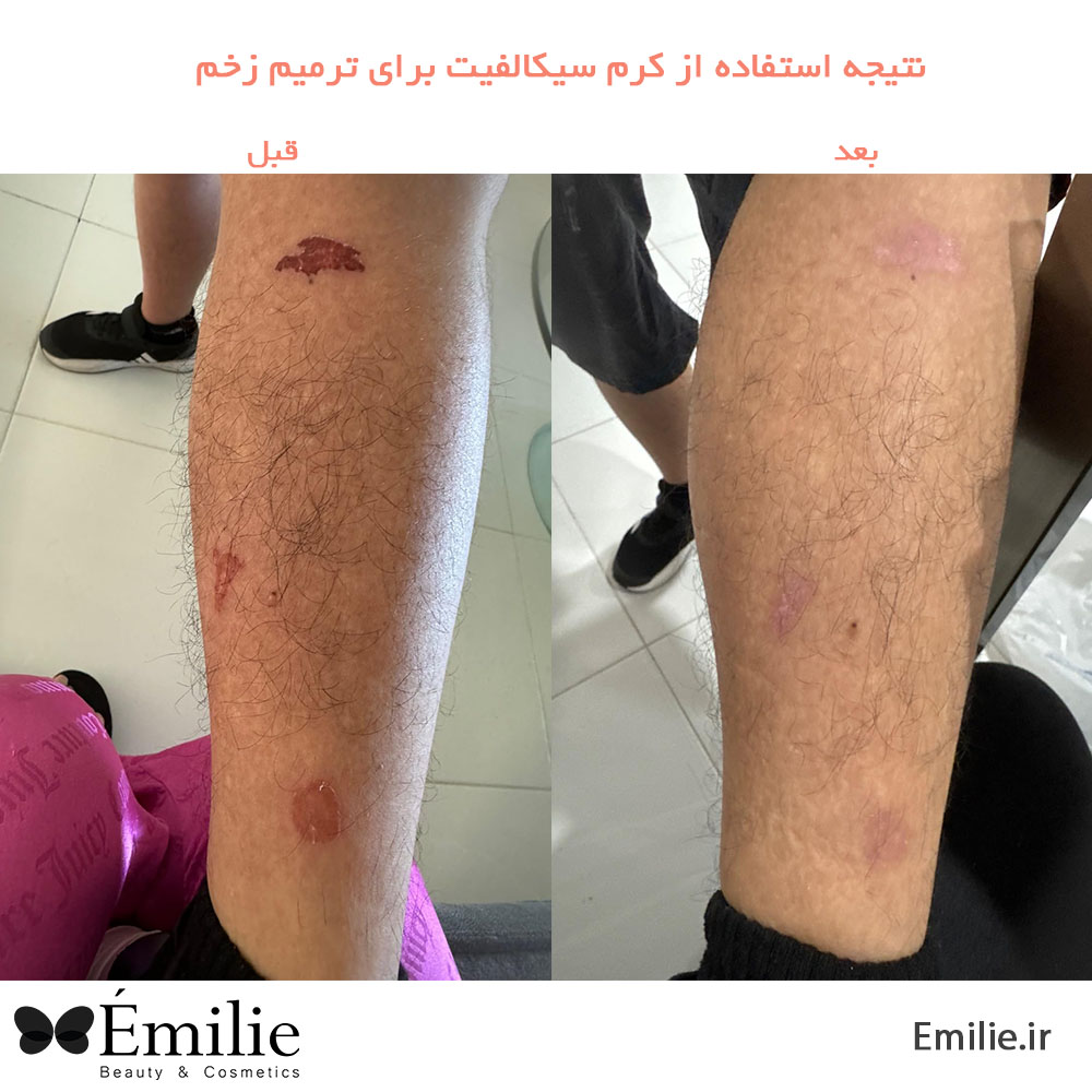 قبل و بعد از استفاده از کرم سیکالفیت2