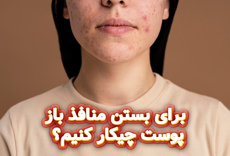 برای-بستن-منافذ-باز-پوست-چیکار-کنیم؟