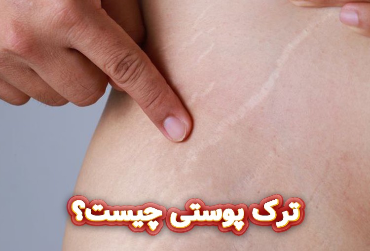 ترک-پوستی-چیست؟