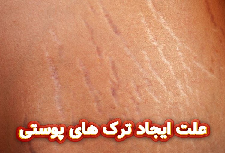 علت-ایجاد-ترک-های-پوستی