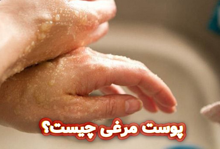 پوست-مرغی-چیست؟