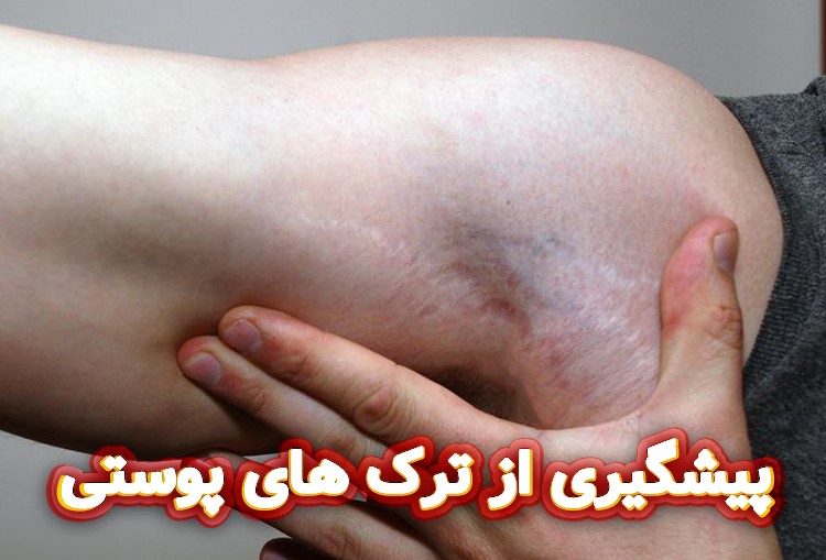 پیشگیری-از-ترک-های-پوستی