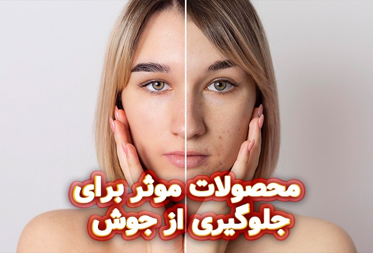 محصولات موثر برای جلوگیری از جوش