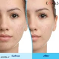 ژل ضدجوش و لایه بردار دیفرین