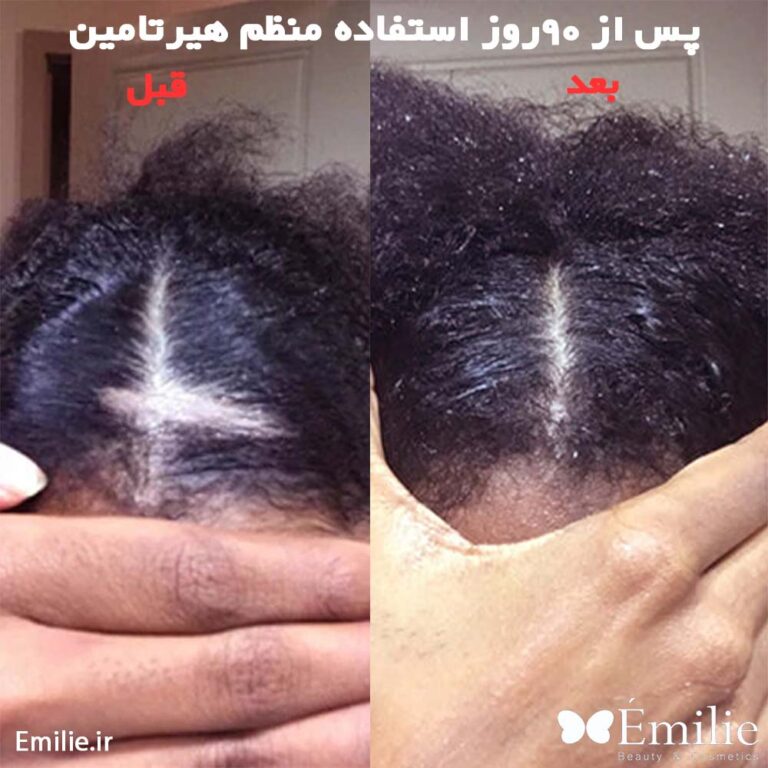 نتایج واقعی قبل و بعد از مصرف قرص هیرتامین(1)