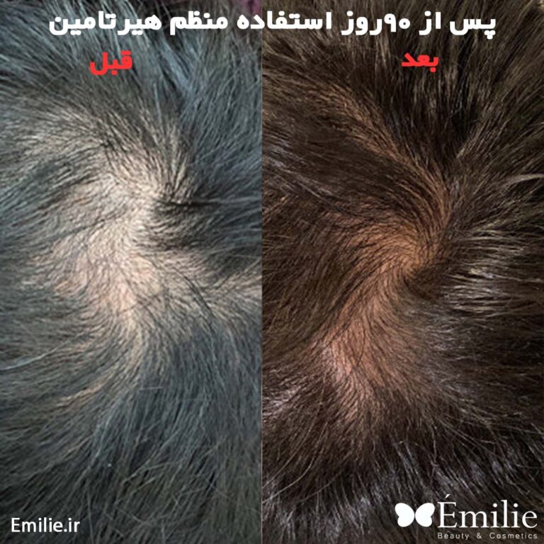 نتایج واقعی قبل و بعد از مصرف قرص هیرتامین(2)