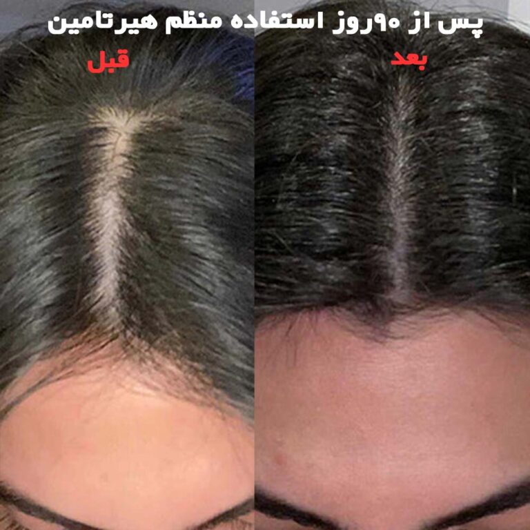 نتایج واقعی قبل و بعد از مصرف قرص هیرتامین(3)