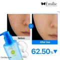 ژل پاک‌ کننده بدون چربی ضد جوش زیرو بلمیش نامبوزین